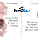 umbilical hernia icd 10