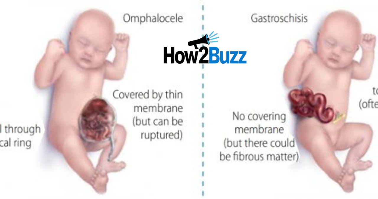 umbilical hernia icd 10